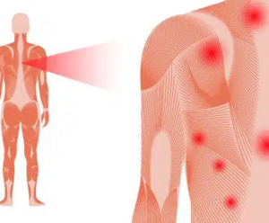 Fibromyalgia