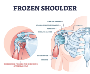 Frozen Shoulder